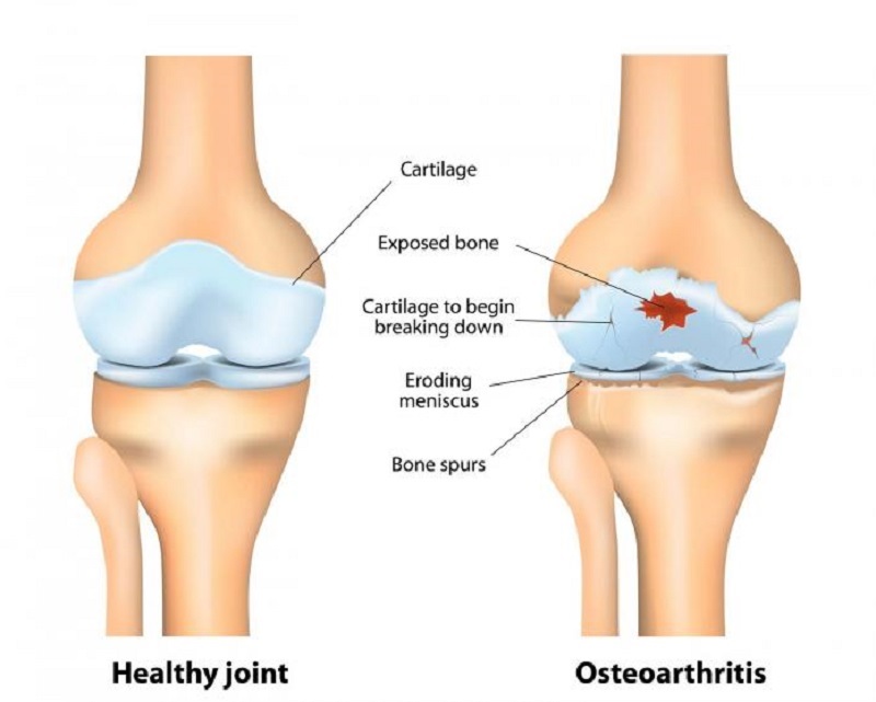 Here are some possible reasons for creaky knees